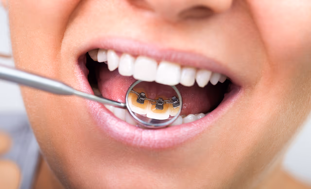 Lingual Braces: How They Work and Who They’re For