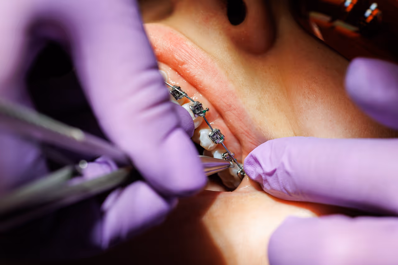 Braces Adjustment Visits: What to Expect and How to Prepare
