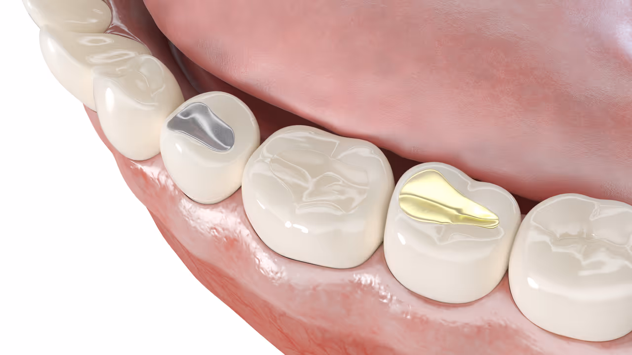 Types of Fillings for Cavities: Which One is Right for You?